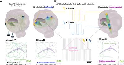 Orientation of Temporal Interference for Non-invasive Deep Brain Stimulation in Epilepsy